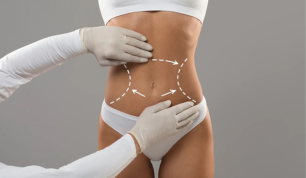 Consultation for body contouring procedure on abdomen.