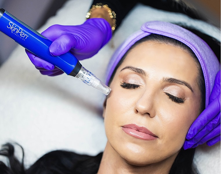 Microneedling procedure with SkinPen device.