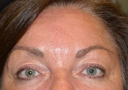 Botox Before & After