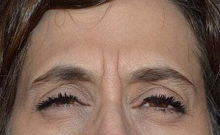 Botox Before & After