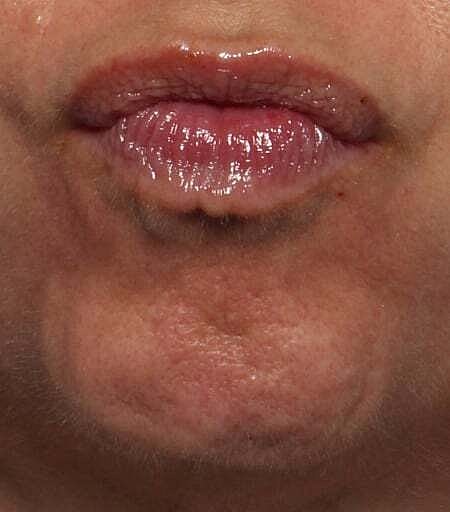 Botox Before & After