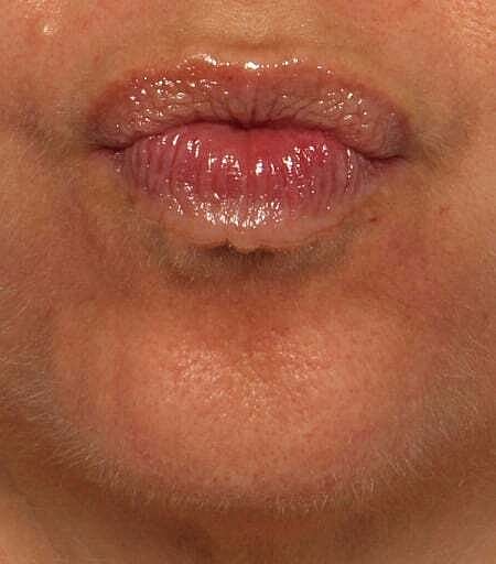 Botox Before & After