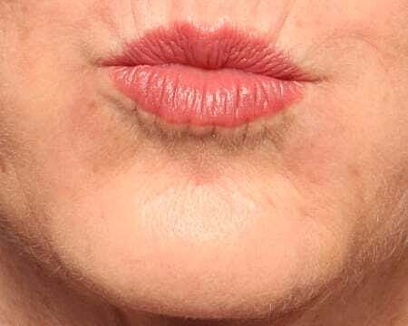Botox Before & After