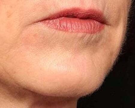 Botox Before & After