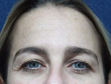 Botox Before & After