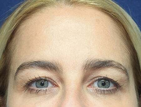 Botox Before & After