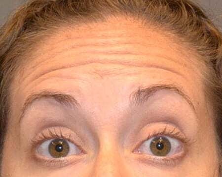 Botox Before & After