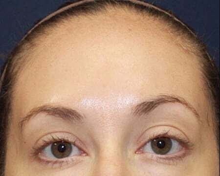 Botox Before & After