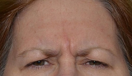 Botox Before & After