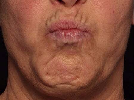 Botox Before & After