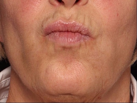 Botox Before & After