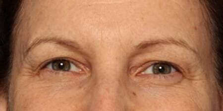 Botox Before & After