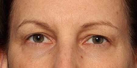 Botox Before & After