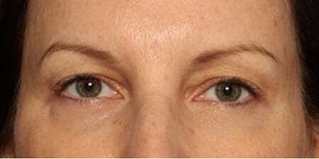 Botox Before & After