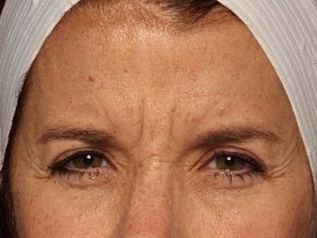Botox Before & After