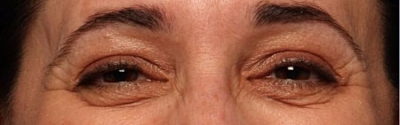 Botox Before & After