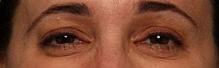 Botox Before & After