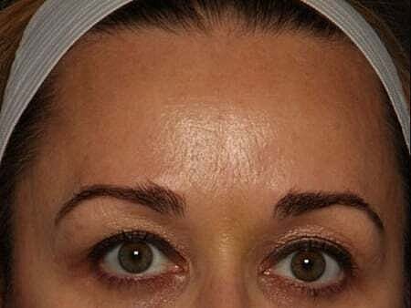 Botox Before & After