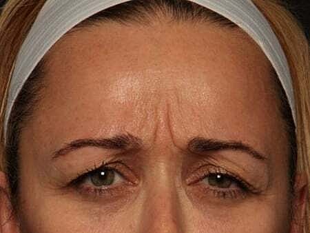 Botox Before & After