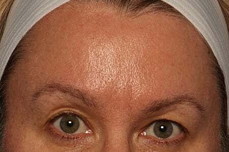 Botox Before & After