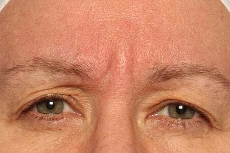 Botox Before & After