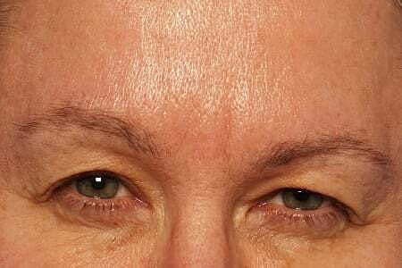 Botox Before & After