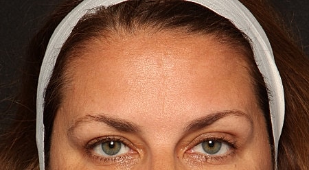 Botox Before & After