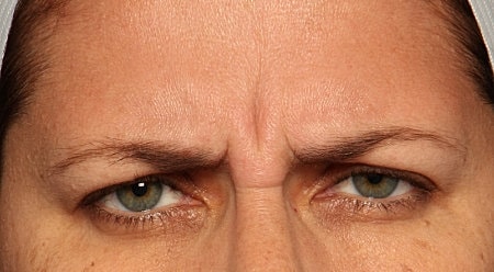 Botox Before & After
