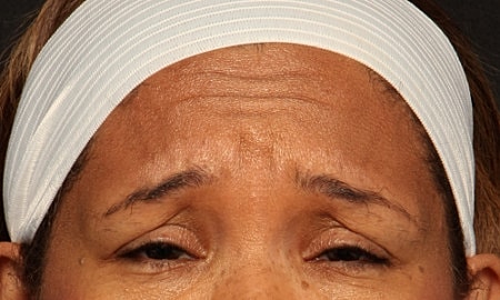 Botox Before & After