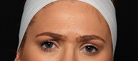 Botox Before & After