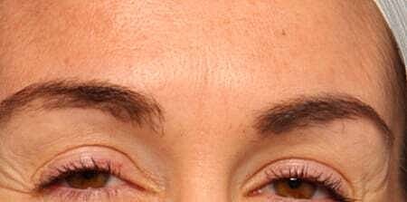 Botox Before & After