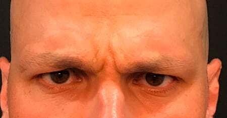 Botox Before & After