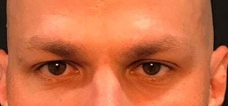 Botox Before & After
