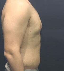 Gynecomastia Before & After