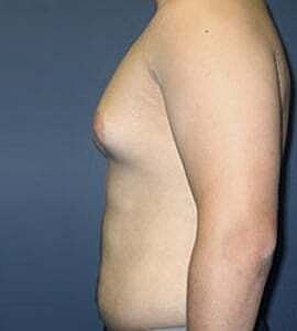Gynecomastia Before & After