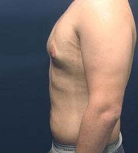 Gynecomastia Before & After