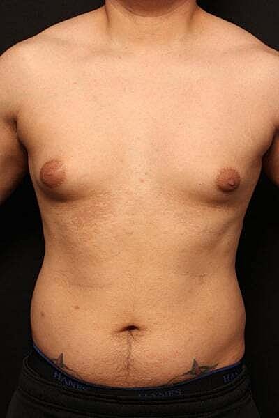 Gynecomastia Before & After