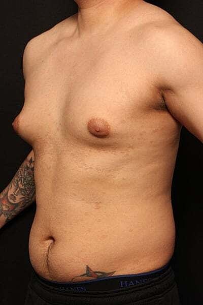 Gynecomastia Before & After