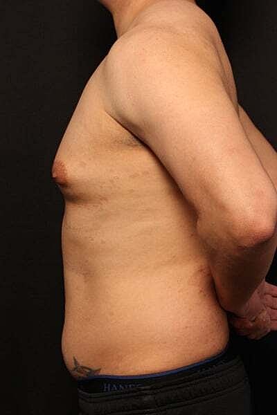 Gynecomastia Before & After
