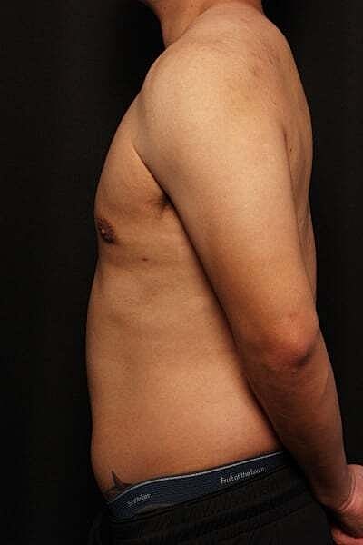 Gynecomastia Before & After