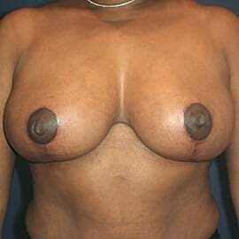 Breast Reduction Before & After