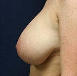 Breast Reduction Before & After