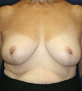 Breast Reduction Before & After