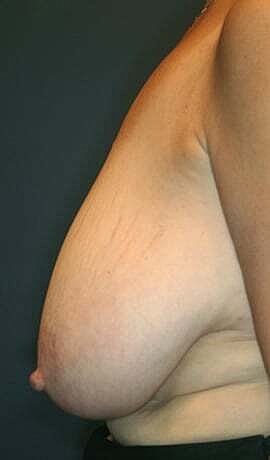 Breast Reduction Before & After