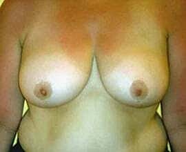 Breast Reduction Before & After
