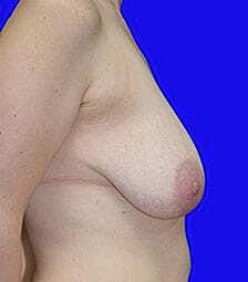 Breast Reduction Before & After