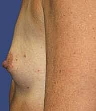 Breast Reconstruction Before & After
