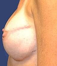 Breast Reconstruction Before & After