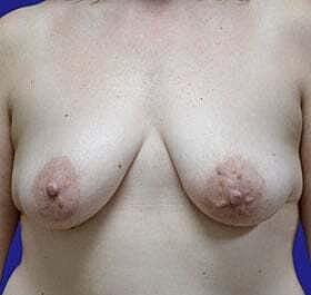Breast Reconstruction Before & After