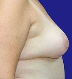 Breast Reconstruction Before & After